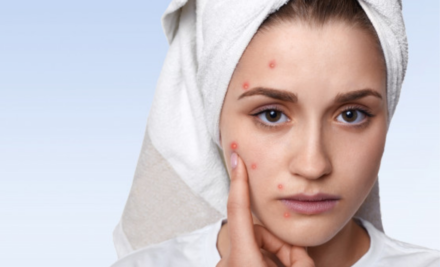 Pelle con imperfezioni: ci facciamo in quattro per sconfiggerla!